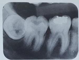 Tilted wisdom tooth towards the cheek