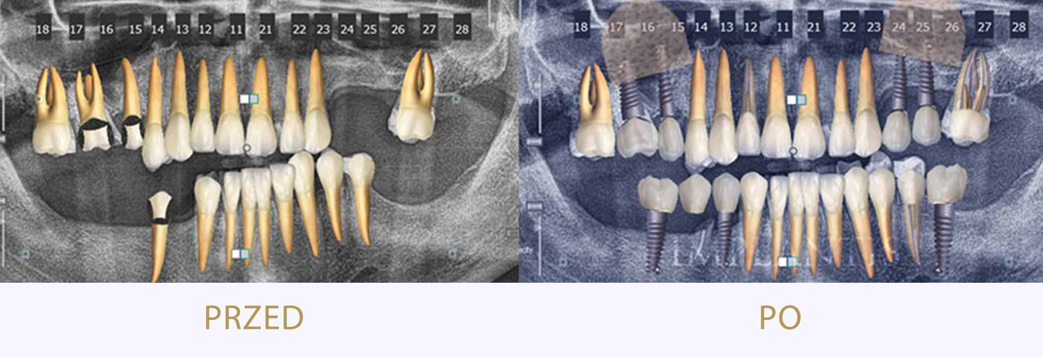 zęby przed i po leczeniu chirurgicznym