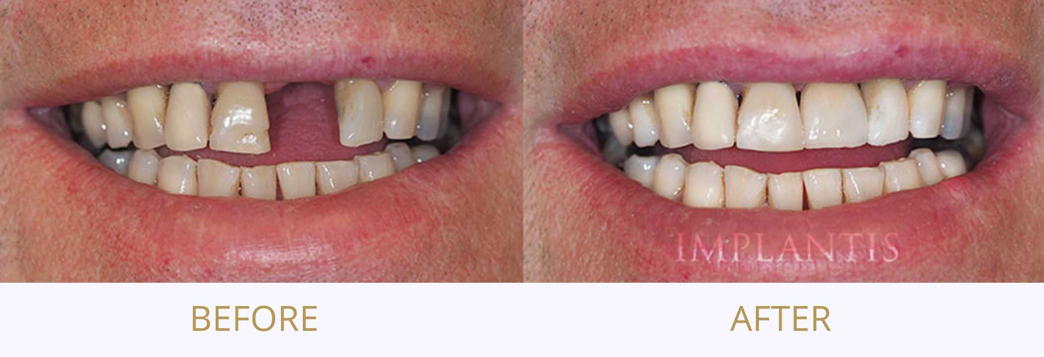 Teeth before and after treatment: Porcelain crown on implant
