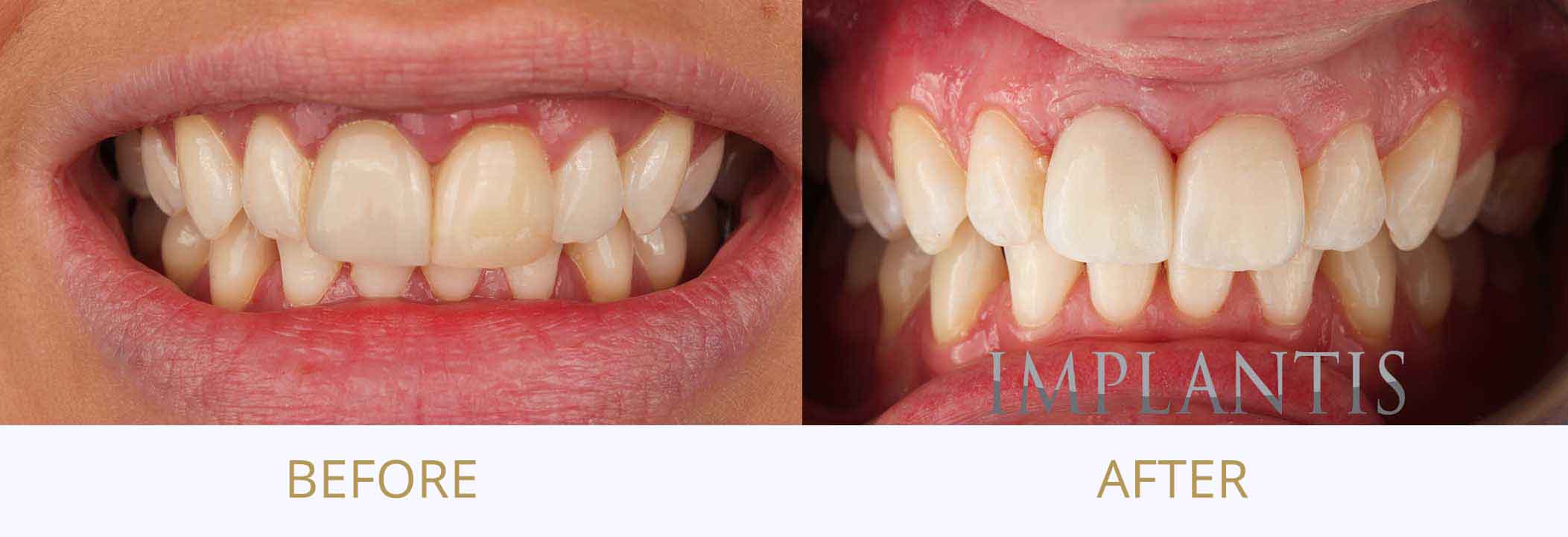 Before and after dental implants comparison.