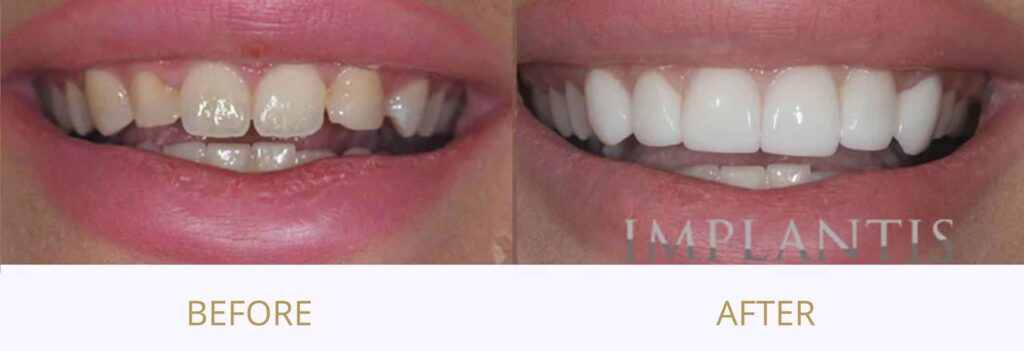 Teeth before and after treatment: Porcelain veneers