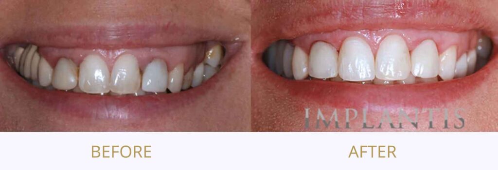 Teeth before and after treatment: Crowns and bonding