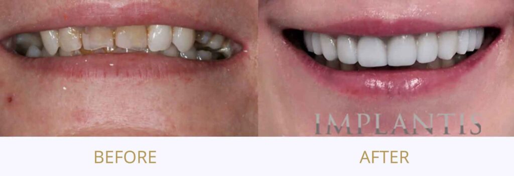 Teeth before and after treatment: Smile reconstruction - crowns, veneers, bridges