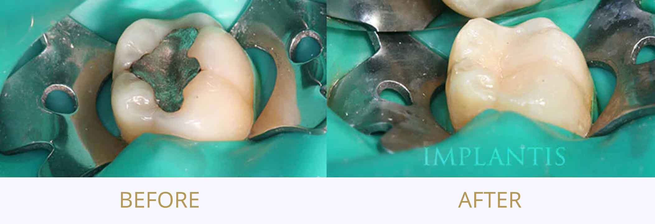 Teeth before and after treatment: Amalgam replacement